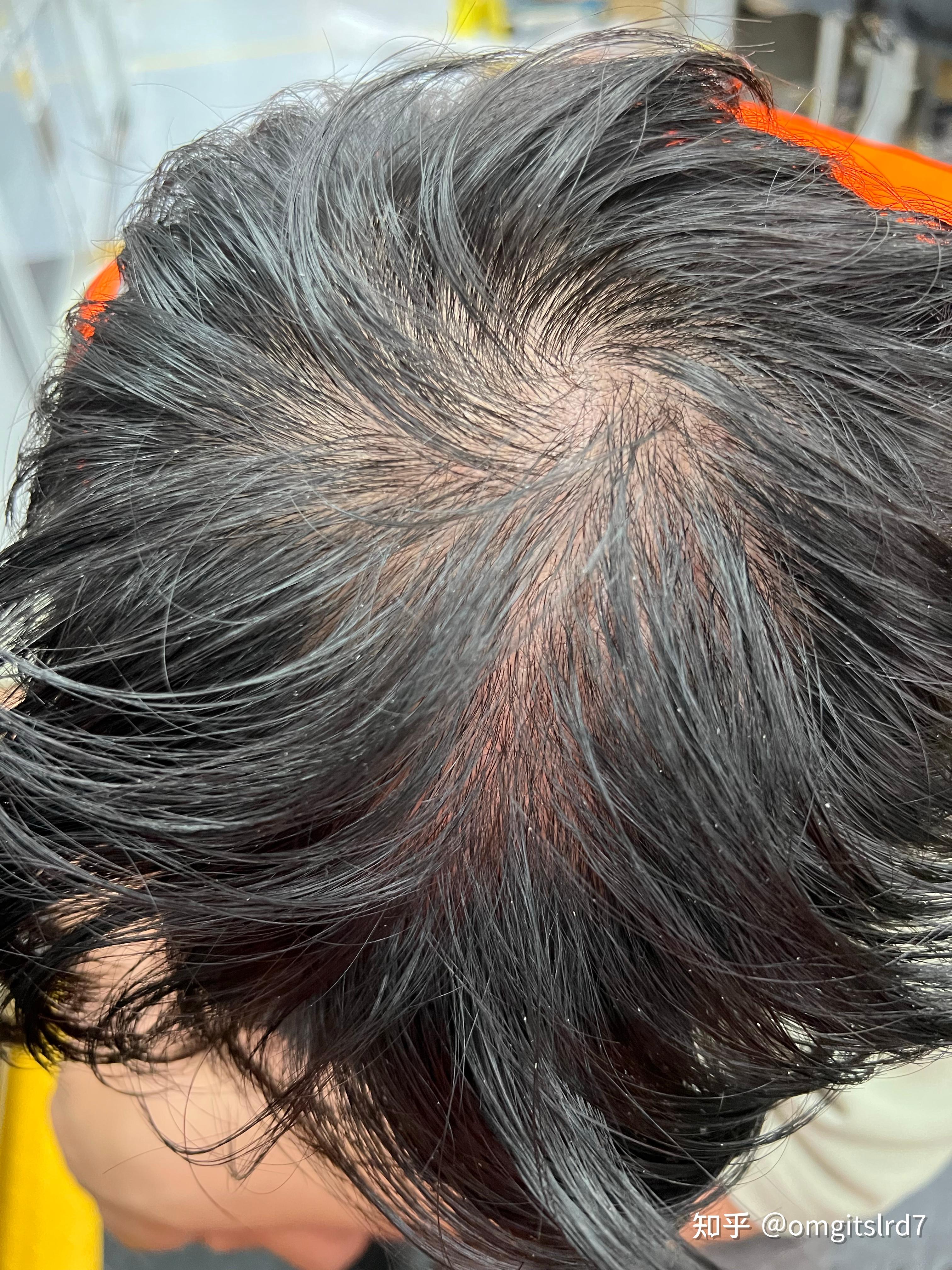 脂溢性脱发还能长吗? - 知乎