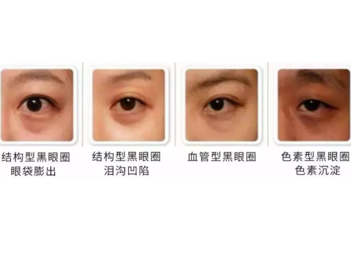 去黑眼圈眼霜如何选2步教你如何选择