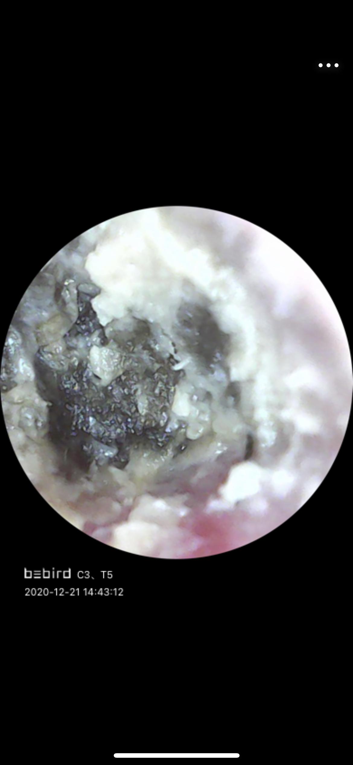 油耳朵腋臭的几率大吗