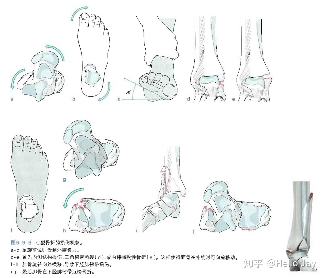 踝关节骨折的治疗原则