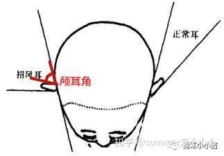 耳朵都开始整容了 是土是洋和耳朵关系大吗 知乎