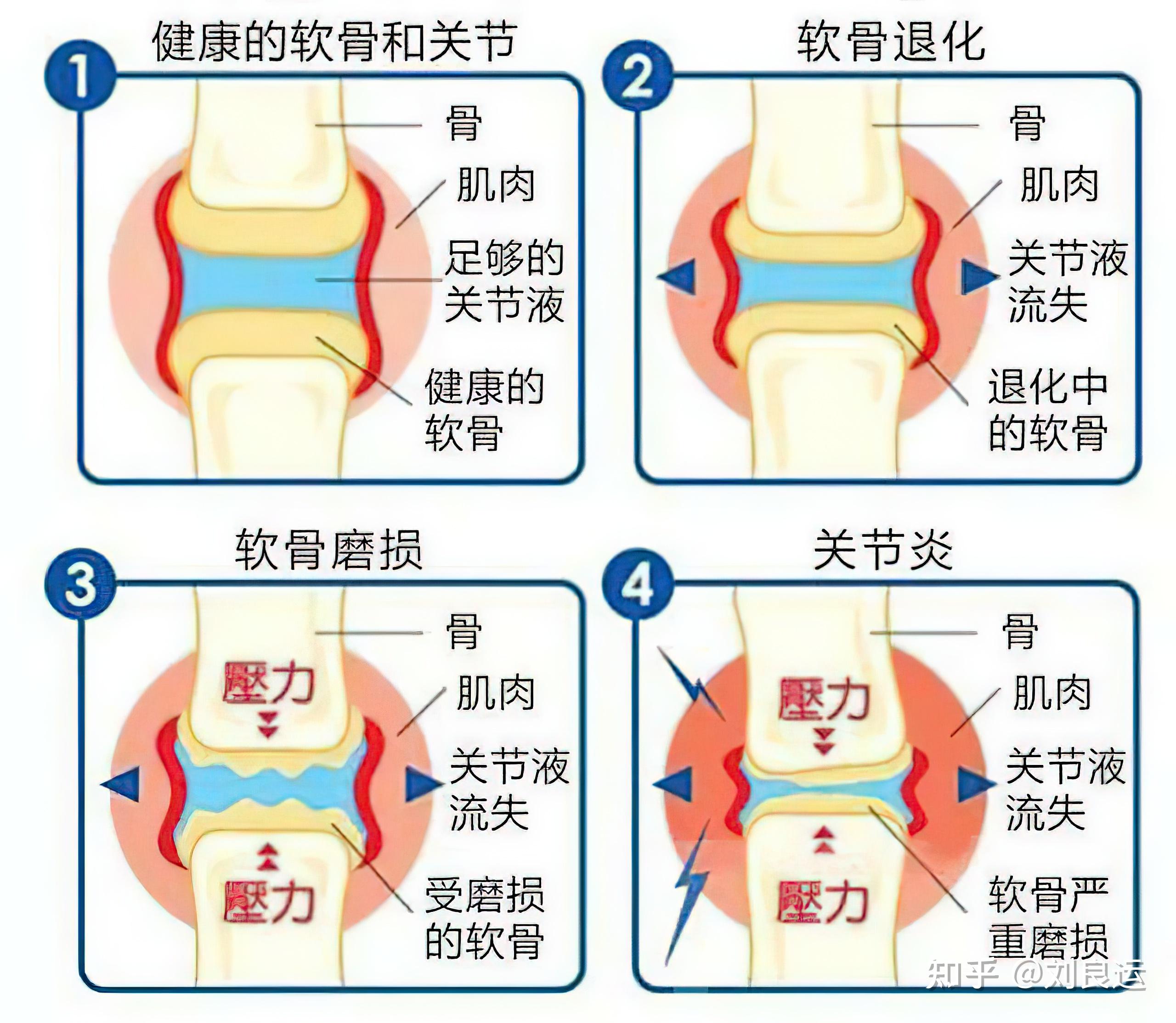 关节炎 成因 、 症状 、 冶疗 和 预防 | 联汇专科中 心 | 香港 | 联汇专科中心