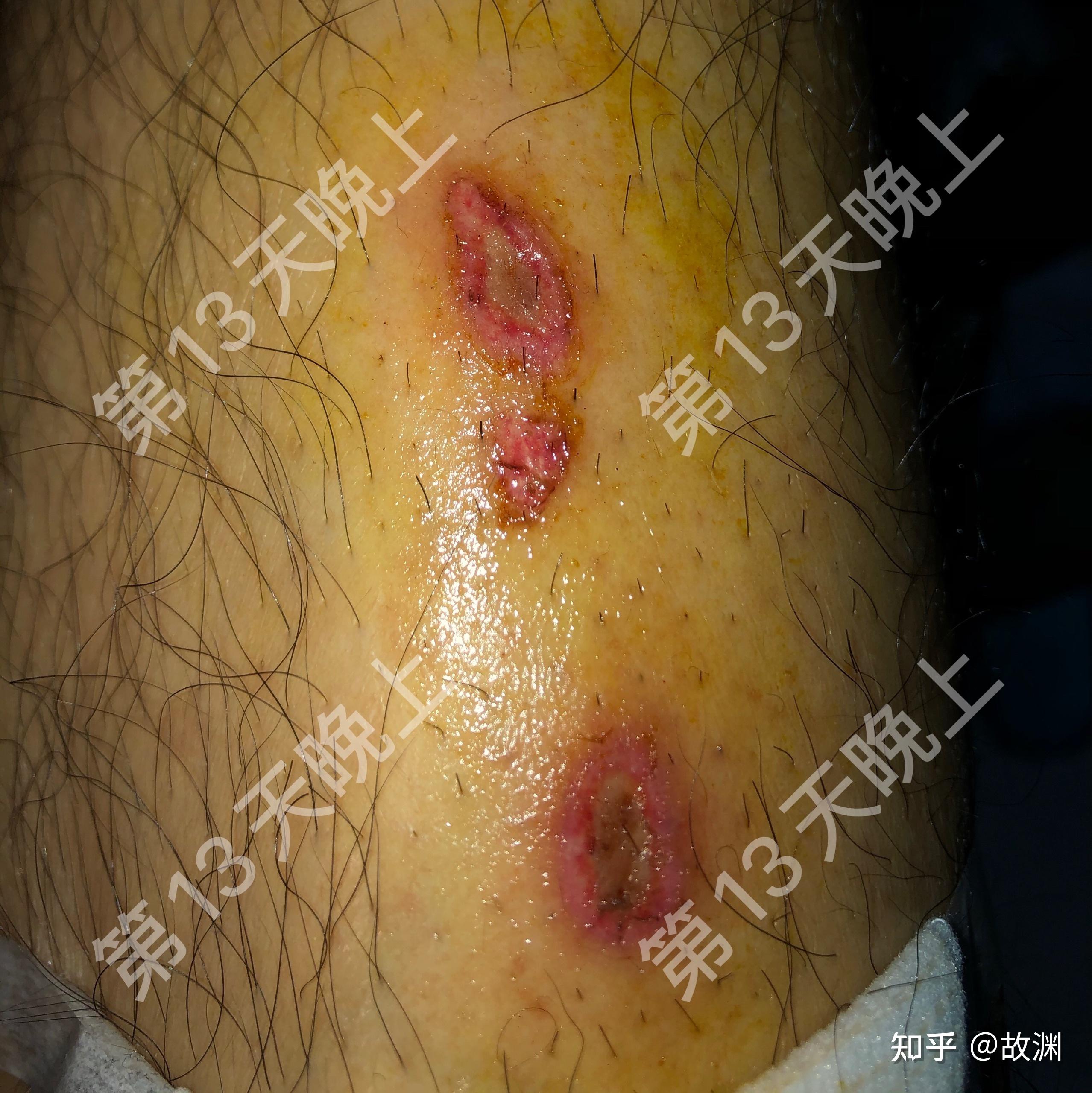 热水袋低温烫伤恢复记录图片可能引起不适