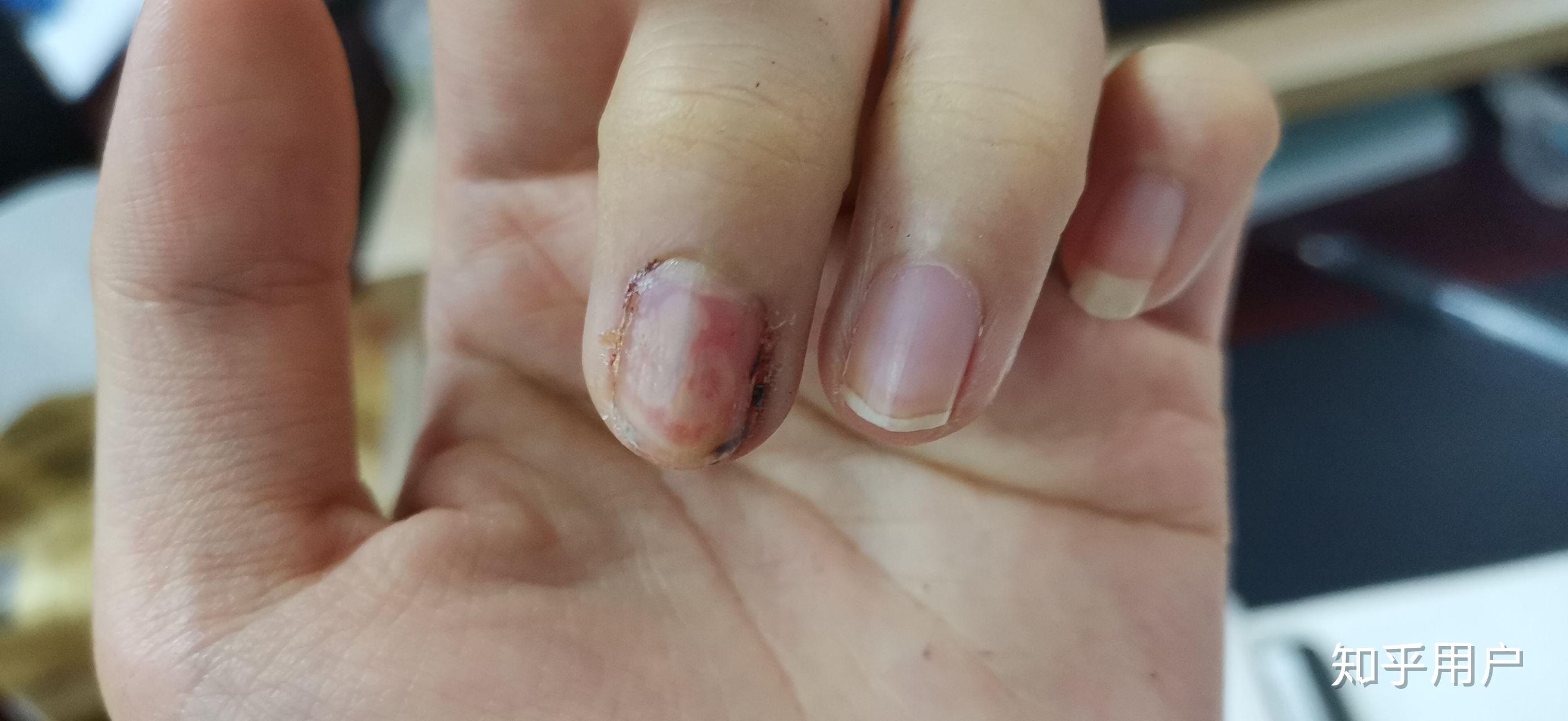 甲分离有六七年了从一个指甲慢慢发现到6个并且脚趾甲也开始空了每年4