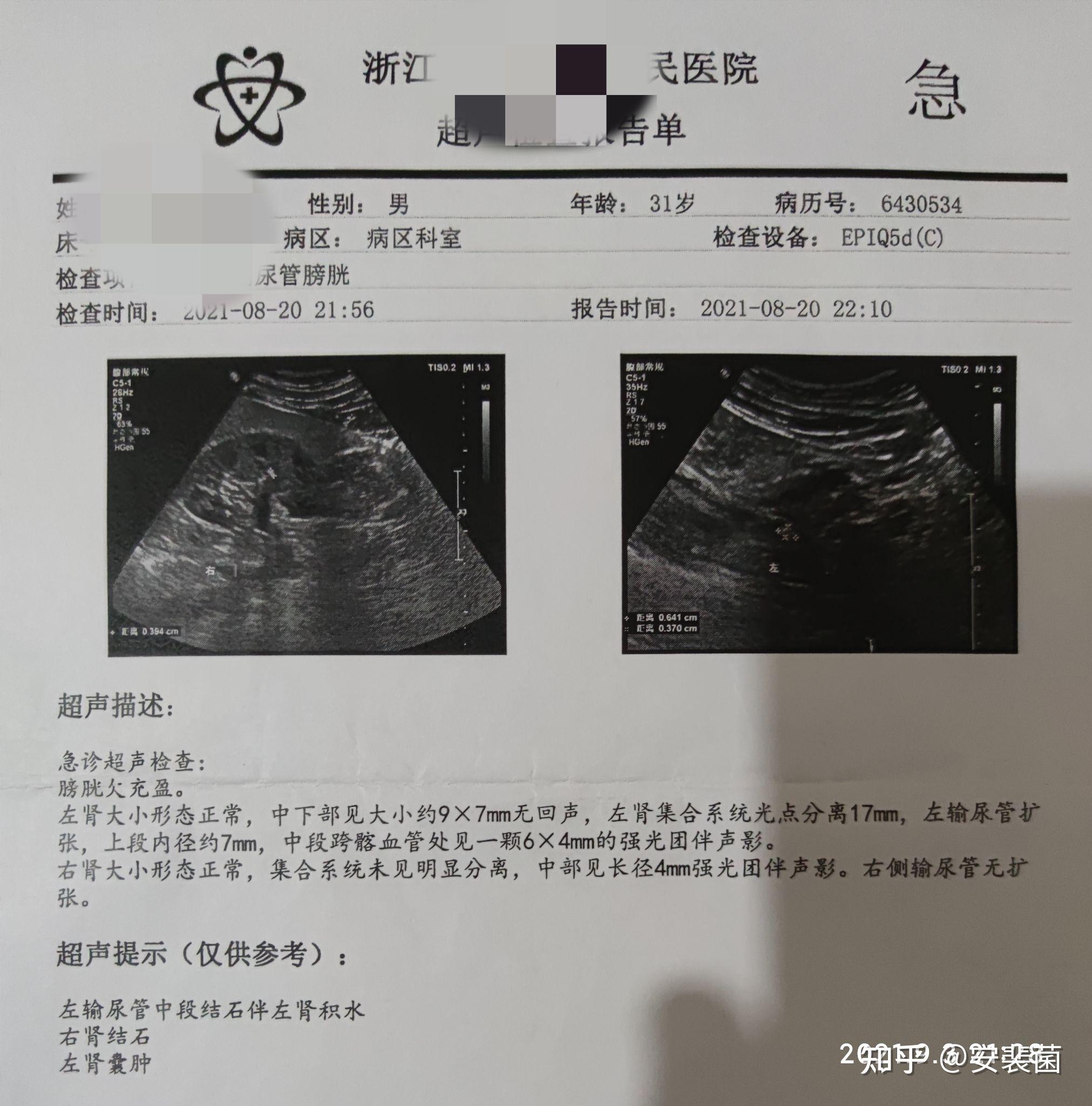 2010年肾结石21年复发,这次历时6个月成功排石! - 知乎