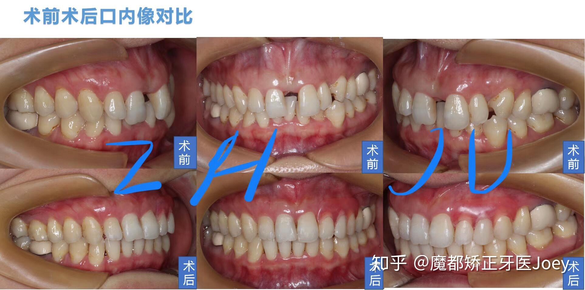 拔虎牙前后对比图片