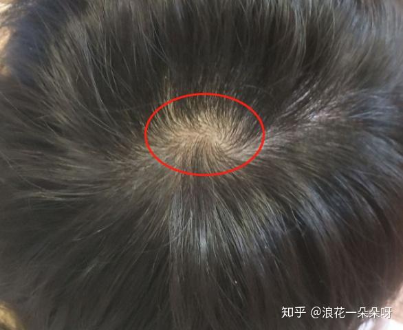 去拍了放大版的发囊,发现发囊里很多头发细的可怜,想问下怎样剃光头能