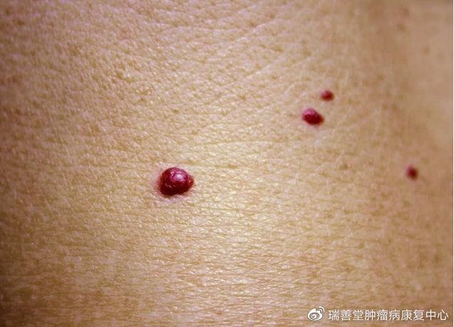 脂肪瘤是怎么回事 会不会癌变 终于有医生说出了答案 知乎 脂肪瘤是怎么回事 会不会癌变 终于有医生说出了答案 知乎