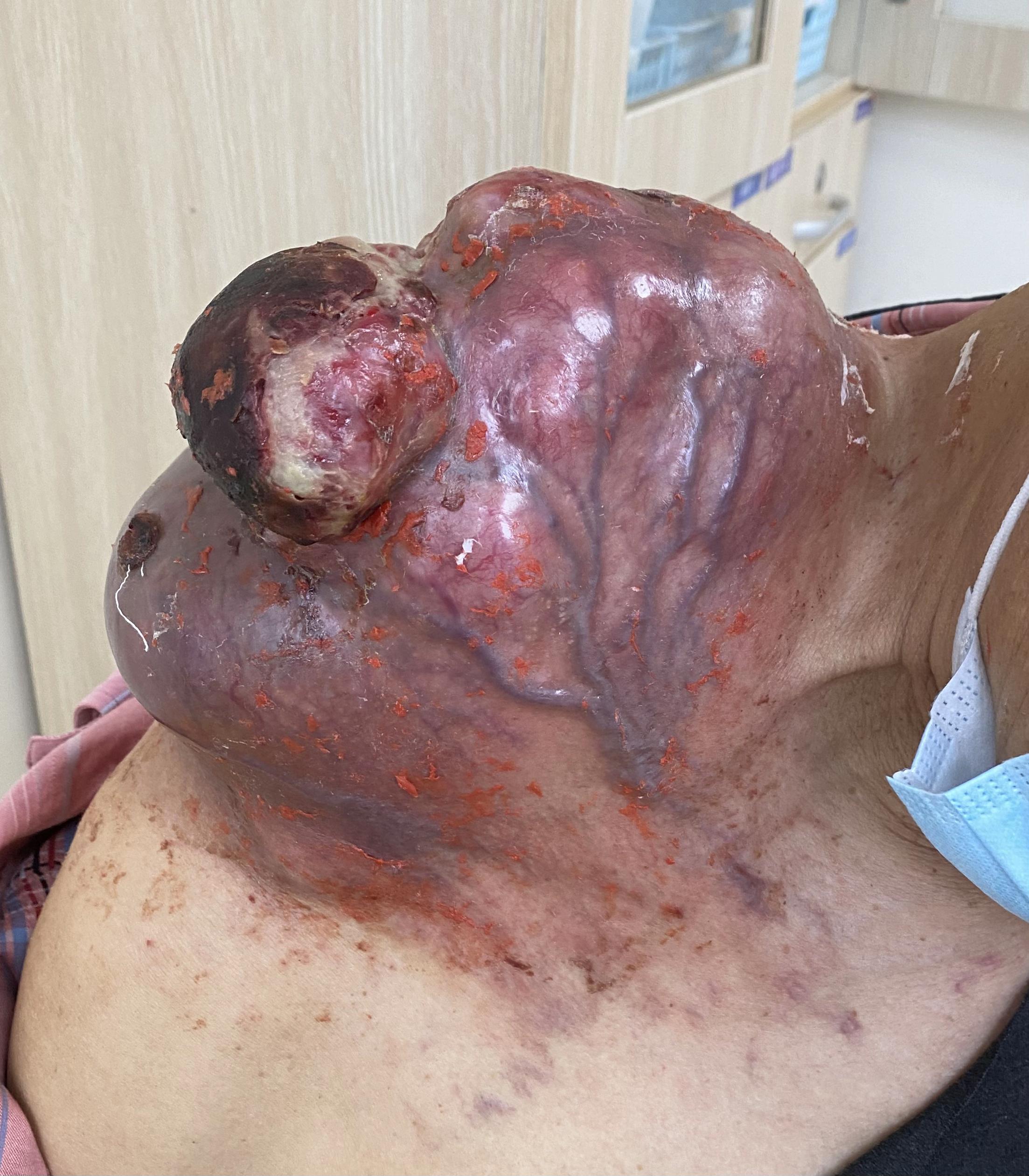 肿瘤长什么样会有很多血管缠绕在周围吗