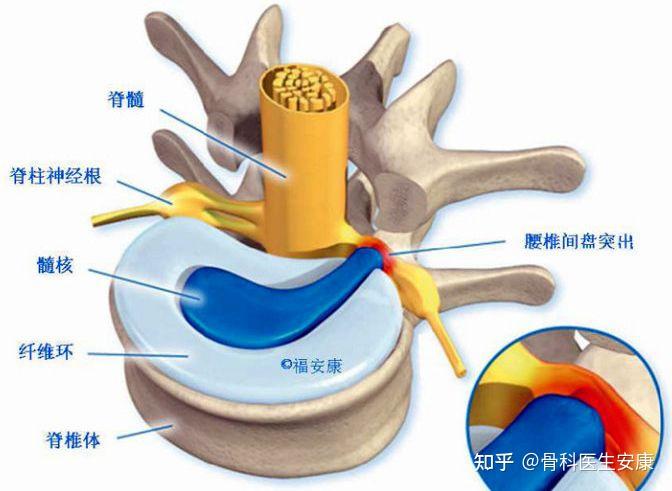 腰间盘突出初期什么症状?