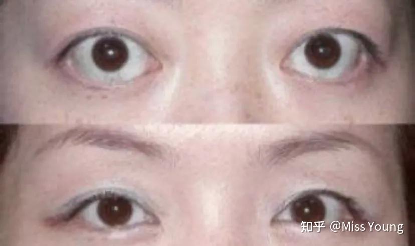 眼睛太凸怎么办?