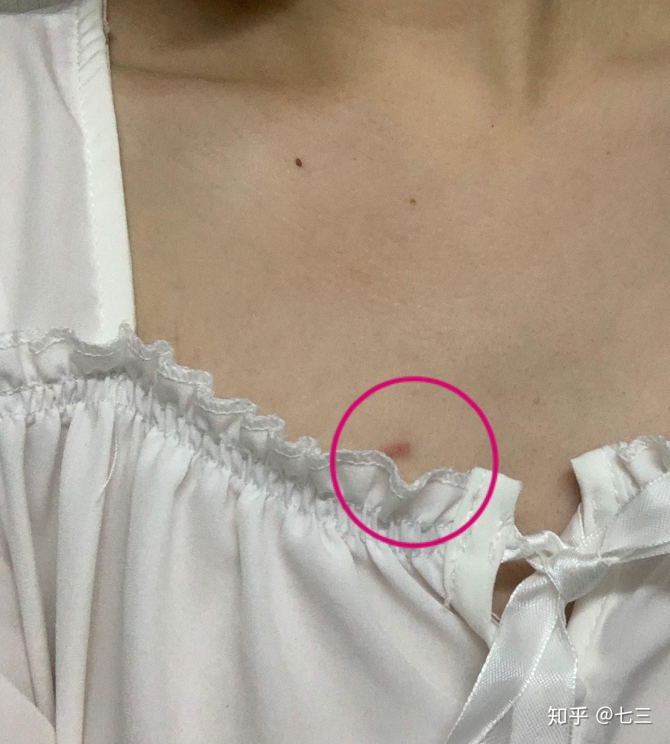 锁骨下面长了红的疙瘩不痛不痒请问怎么消除有图