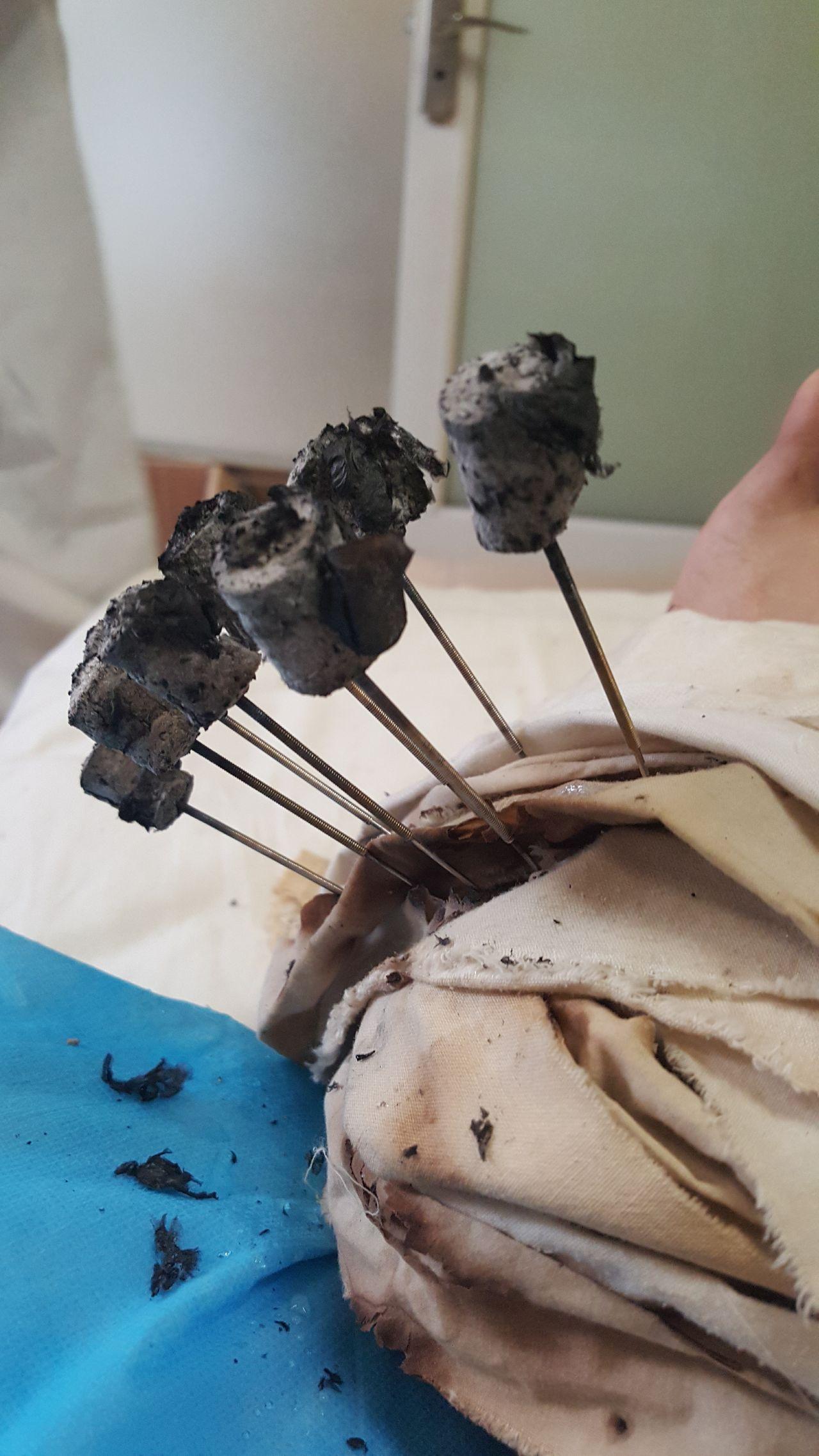 有谁了解密集型银质针松解术么? - 知乎