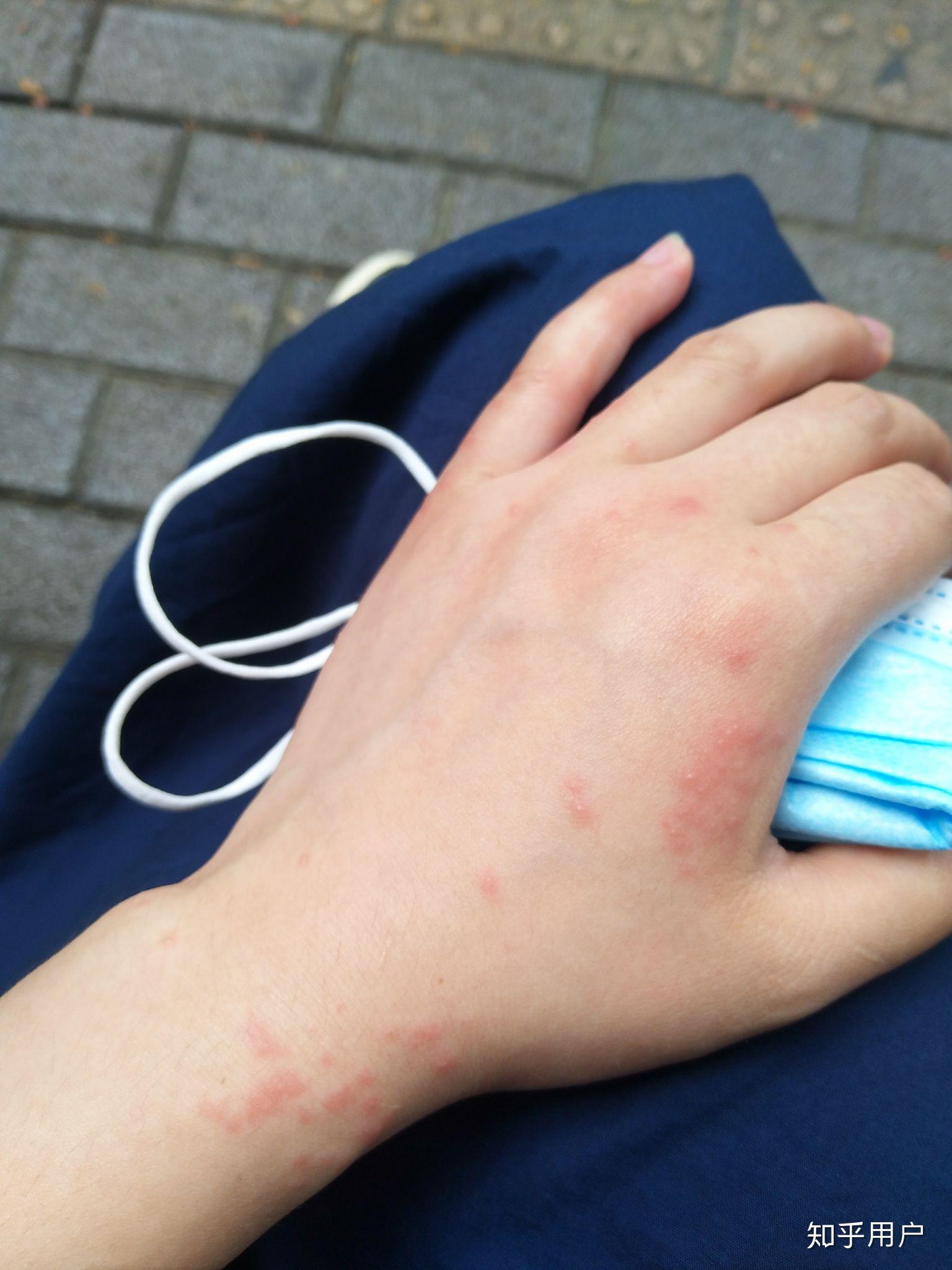 臭虫咬过的疙瘩什么样