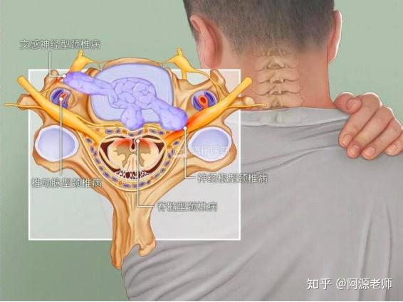 是一种颈椎的退化,影响到颈椎所有的部位,包括椎间盘,神经,动脉,脊髓