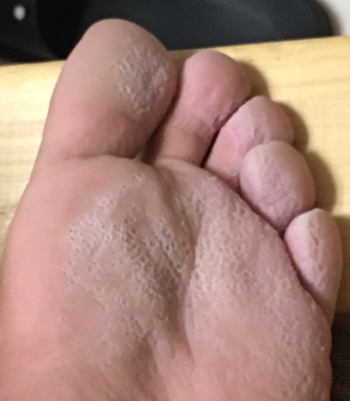 脚非常臭,脚底板发白,还有蜂窝状小坑该怎么办?