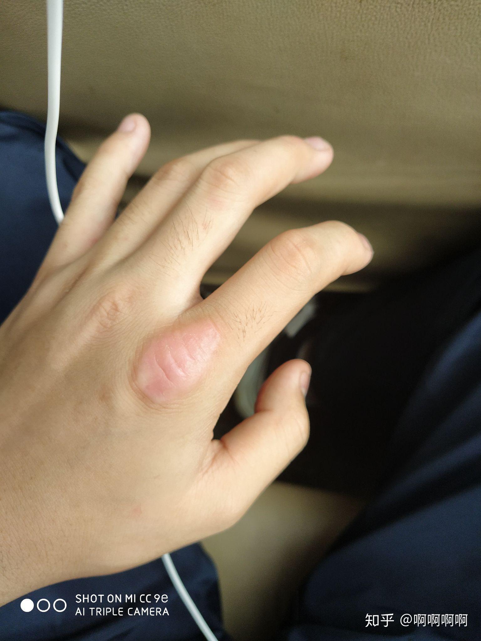 手指关节出皮肤变厚原来的纹路消失为什么会这样? - 知乎