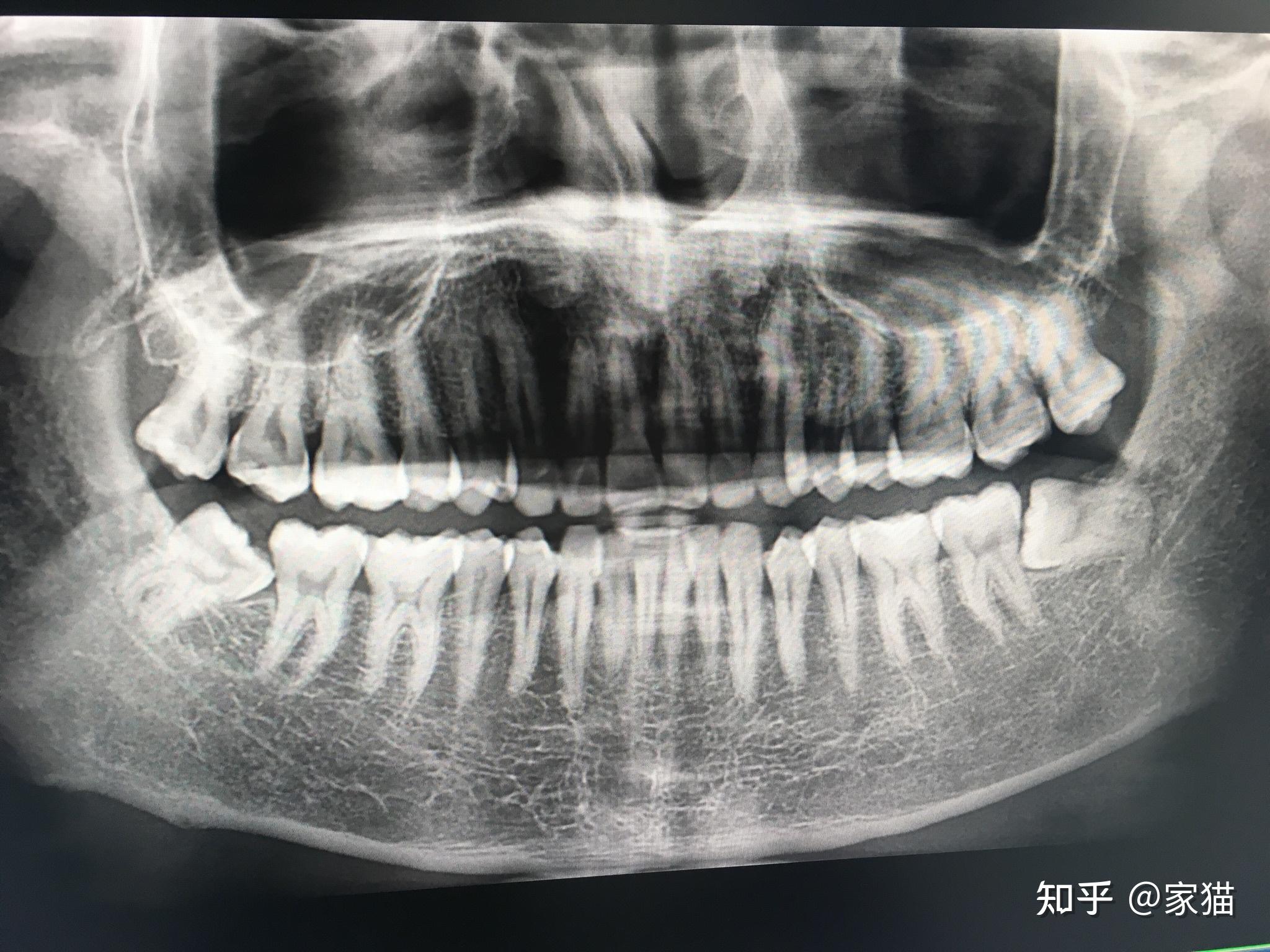 一次性拔掉四個智齒會死嗎