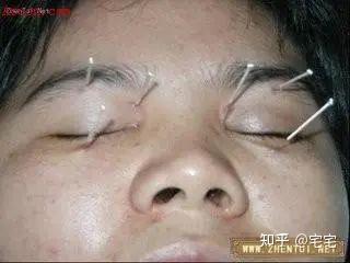 图解靳三针 - 知乎