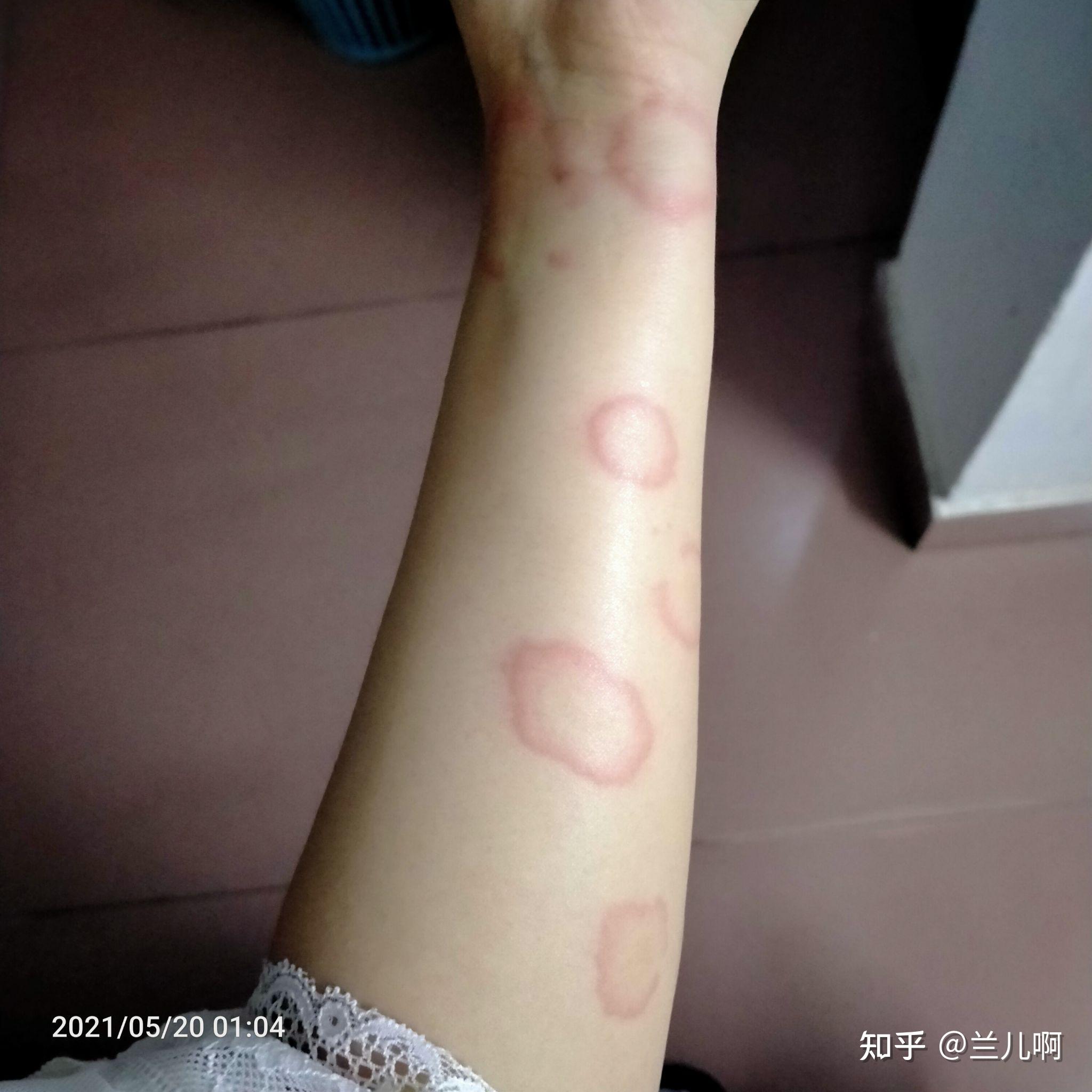 治疗荨麻疹过程