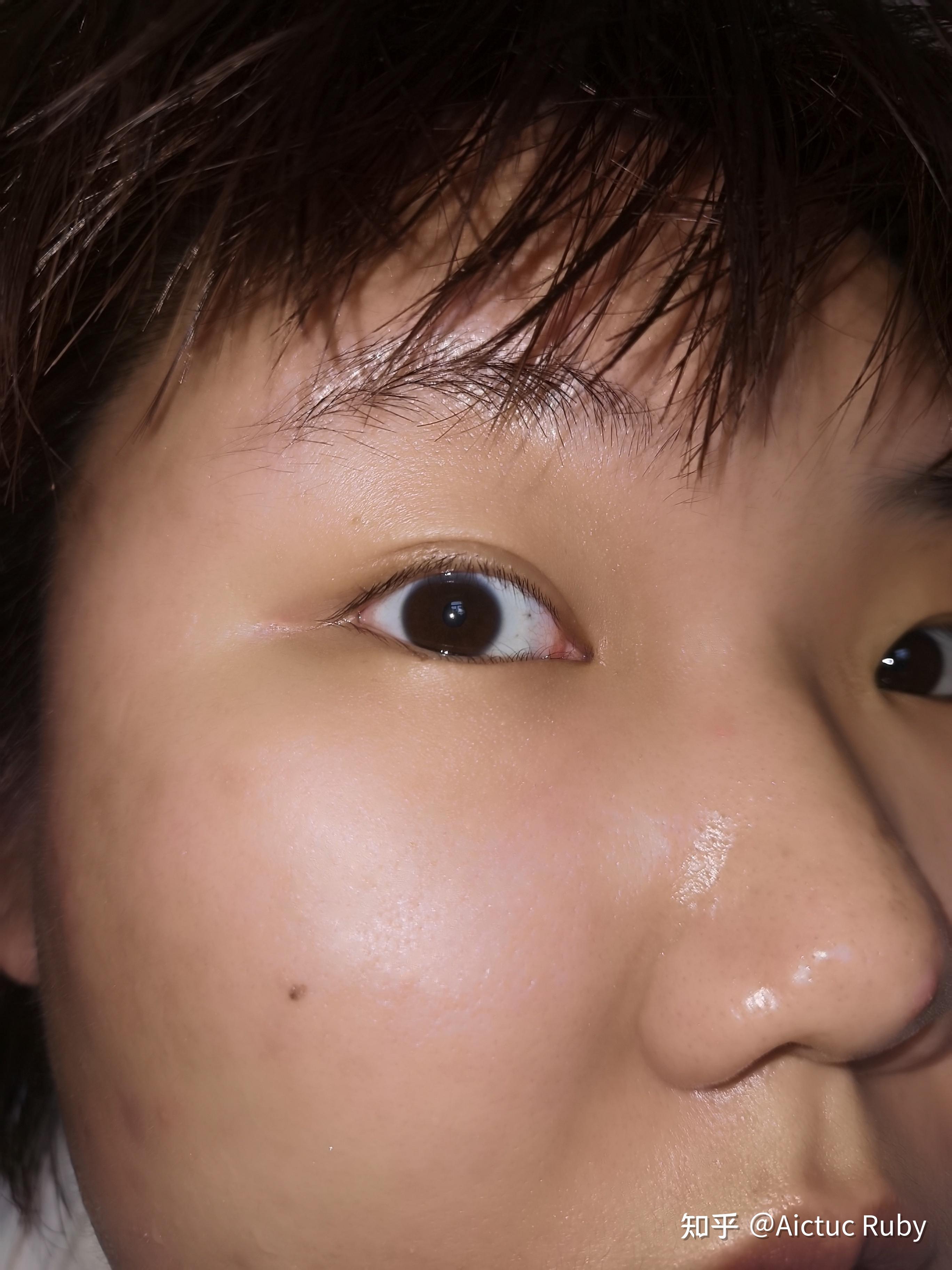 什么是双睫症?身边有这样的朋友吗? - 知乎