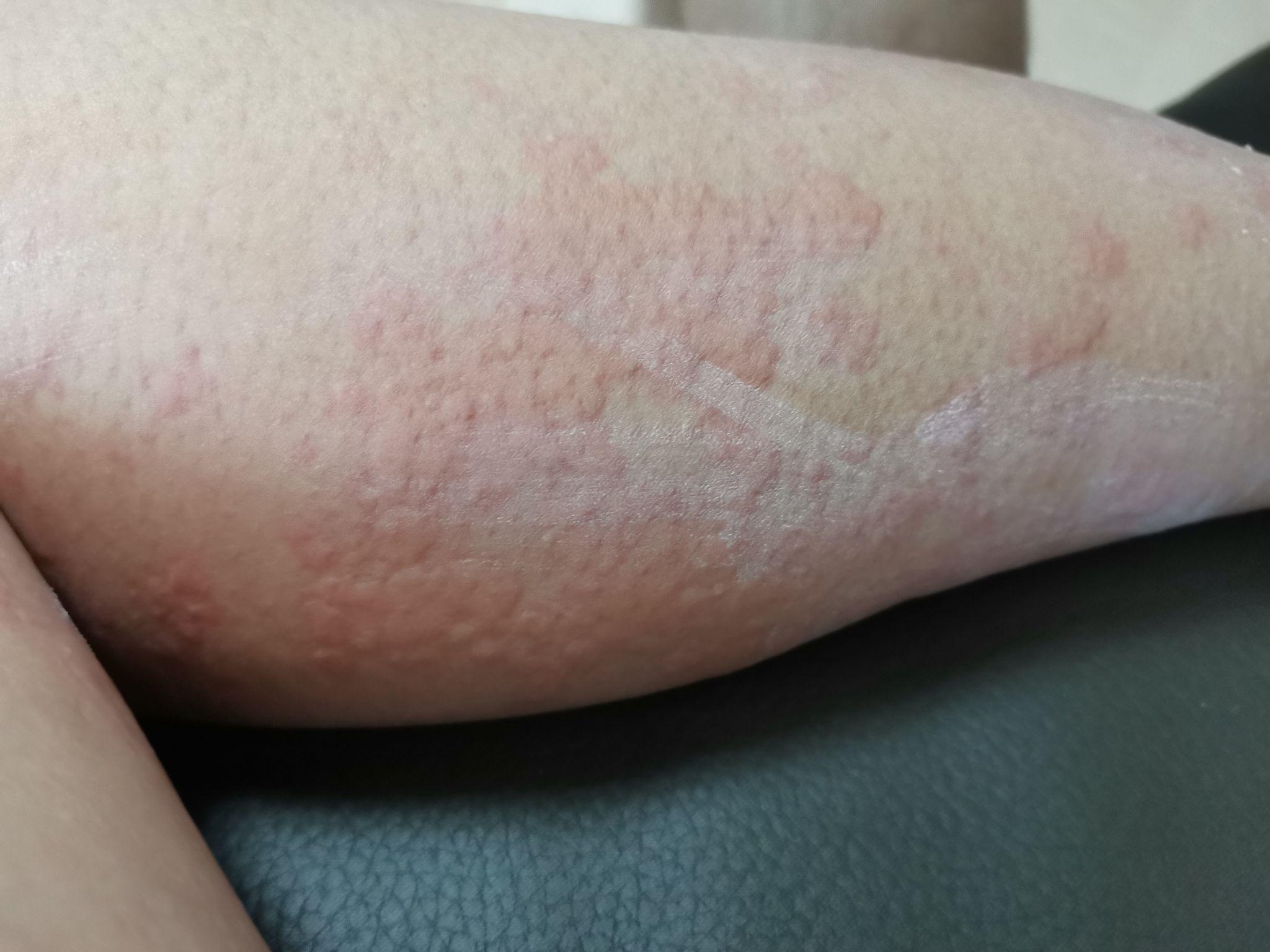 奇痒难耐的荨麻疹发病期