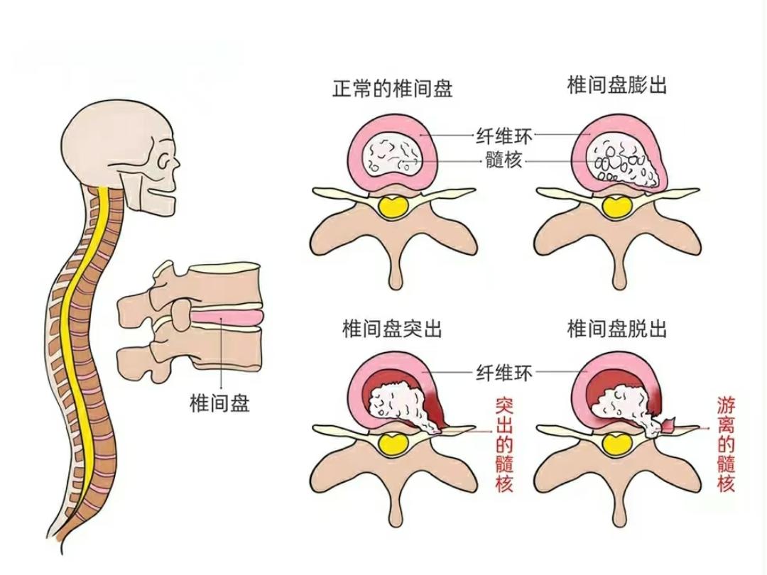 腰间盘突出最好的治疗方法