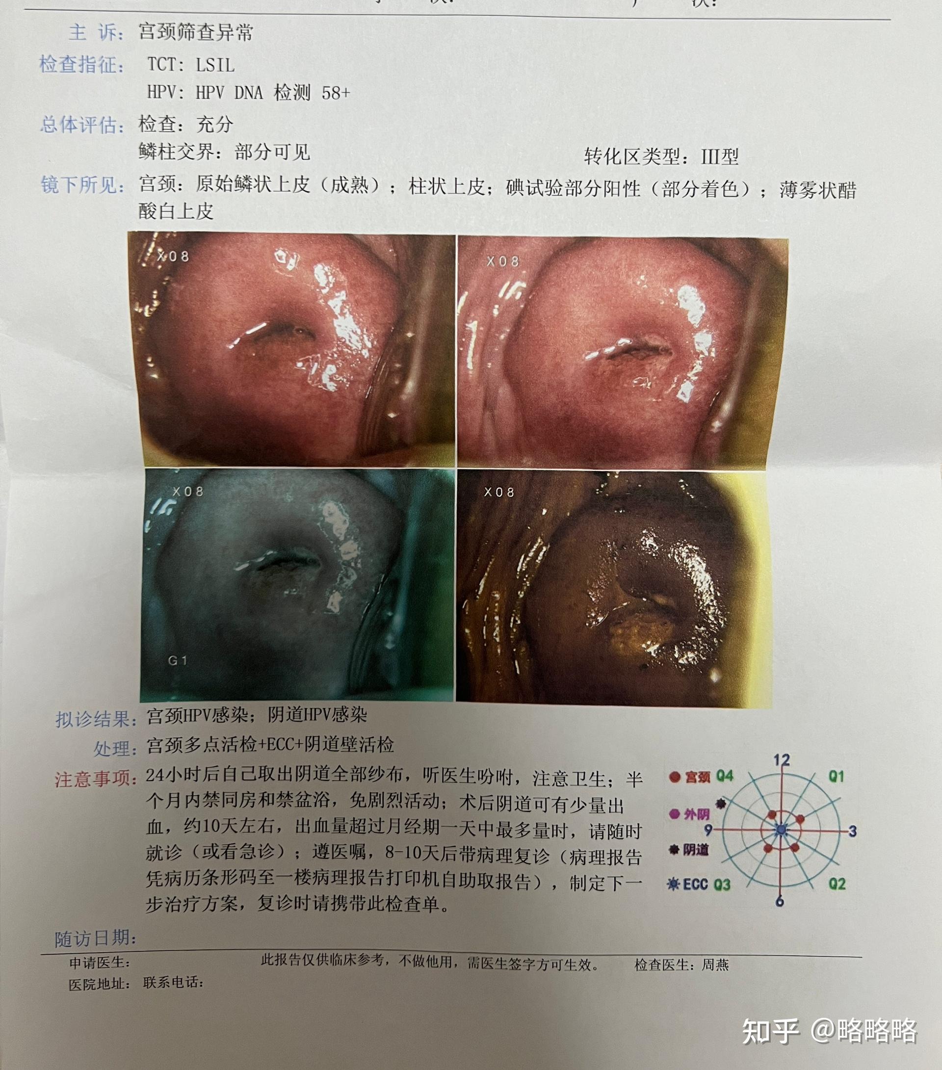 2个月的检查最终hpv阴tct低度病变阴道镜活检病理宫颈组织慢性炎伴鳞