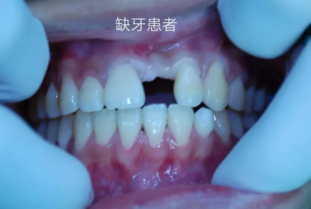 有良知的牙科医生都在实名反对的牙科治疗术