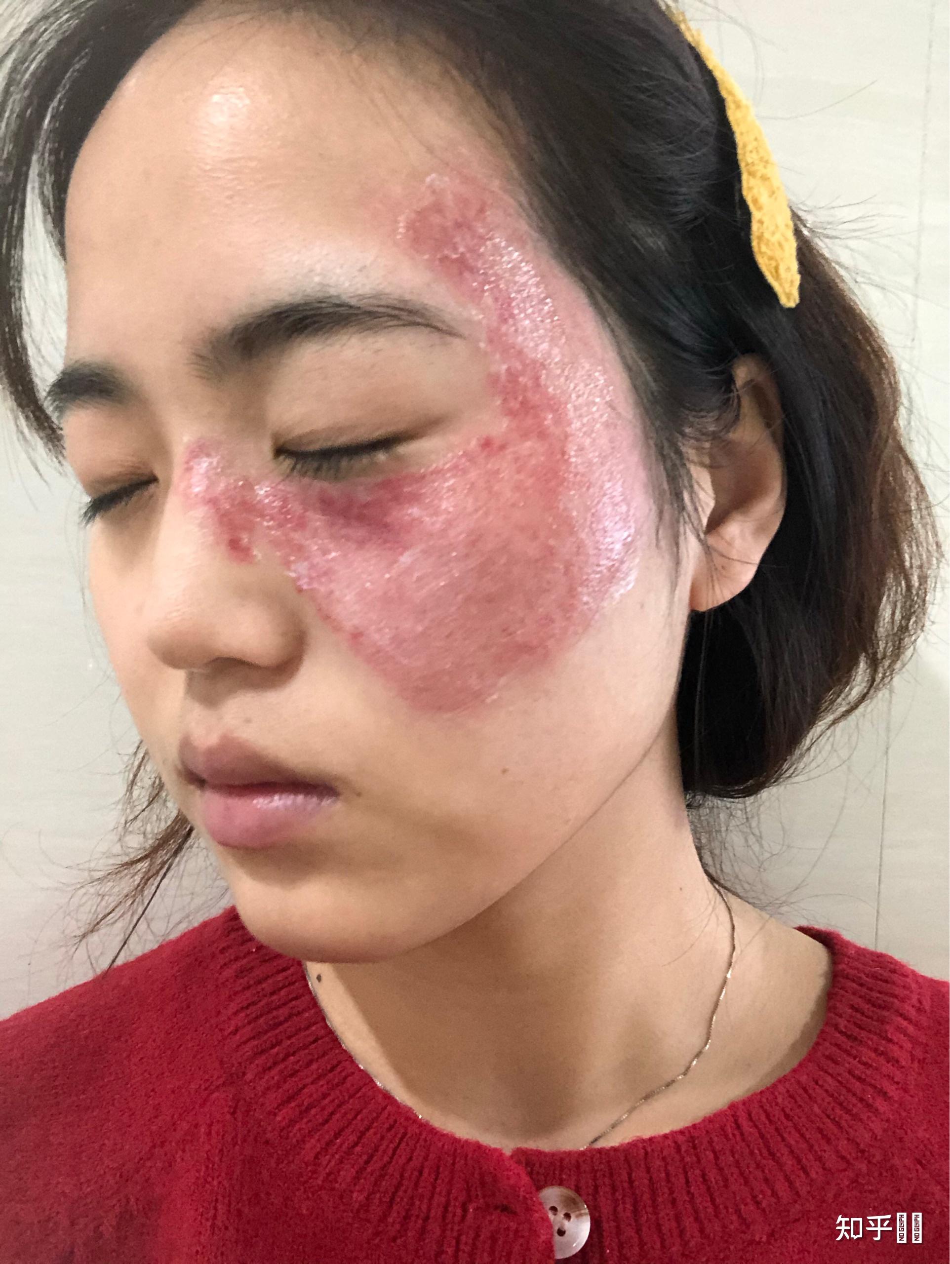 太田痣激光手术后几天可以见人呢? - 知乎