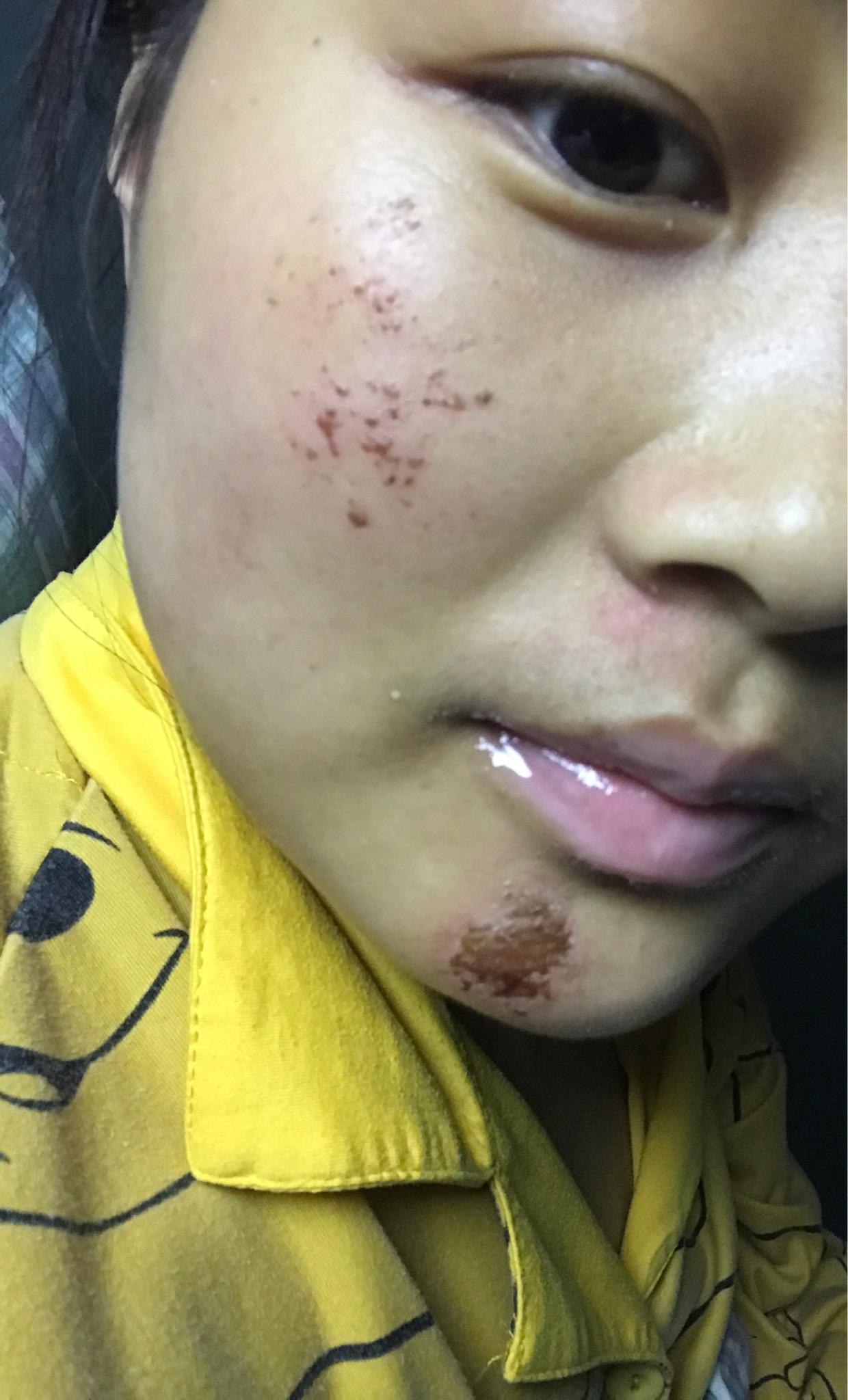 脸部擦伤如图,请问如何恢复? - 知乎