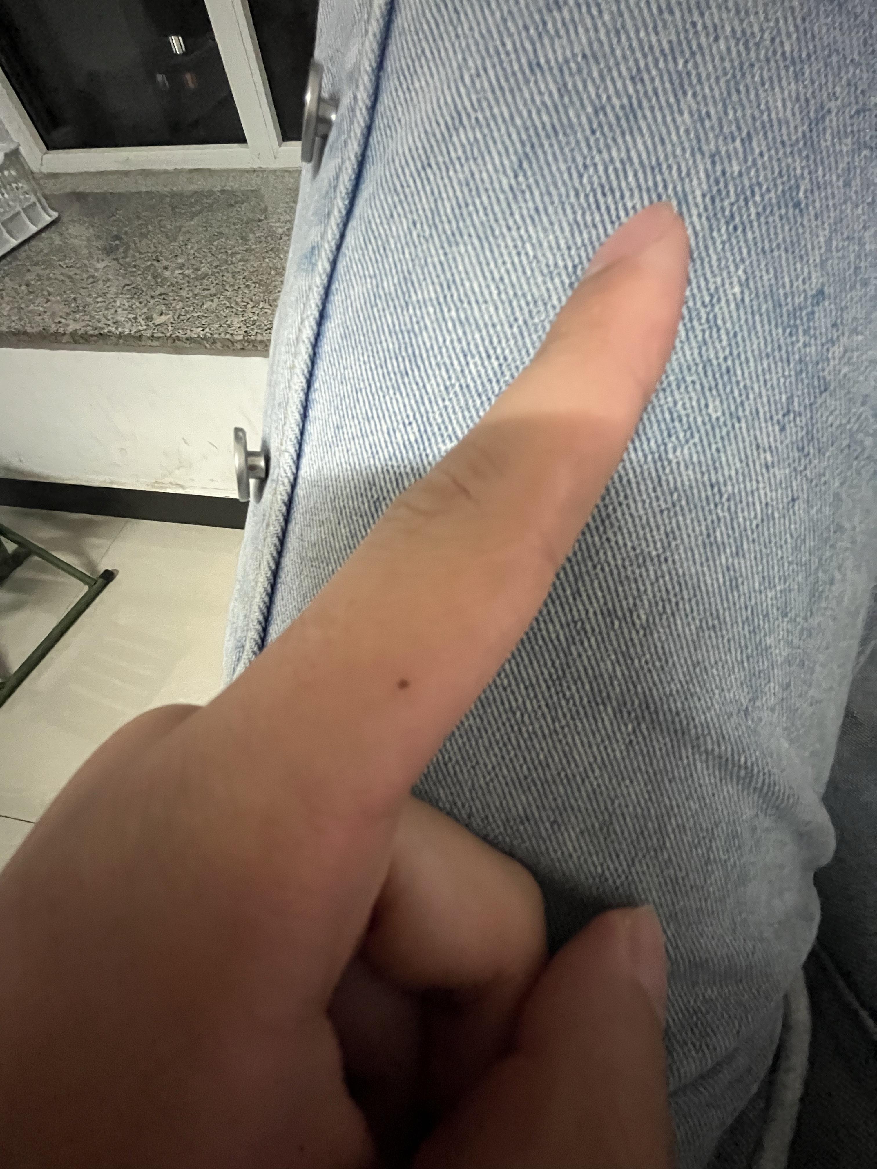 左手食指突然长了痣这是为什么 知乎