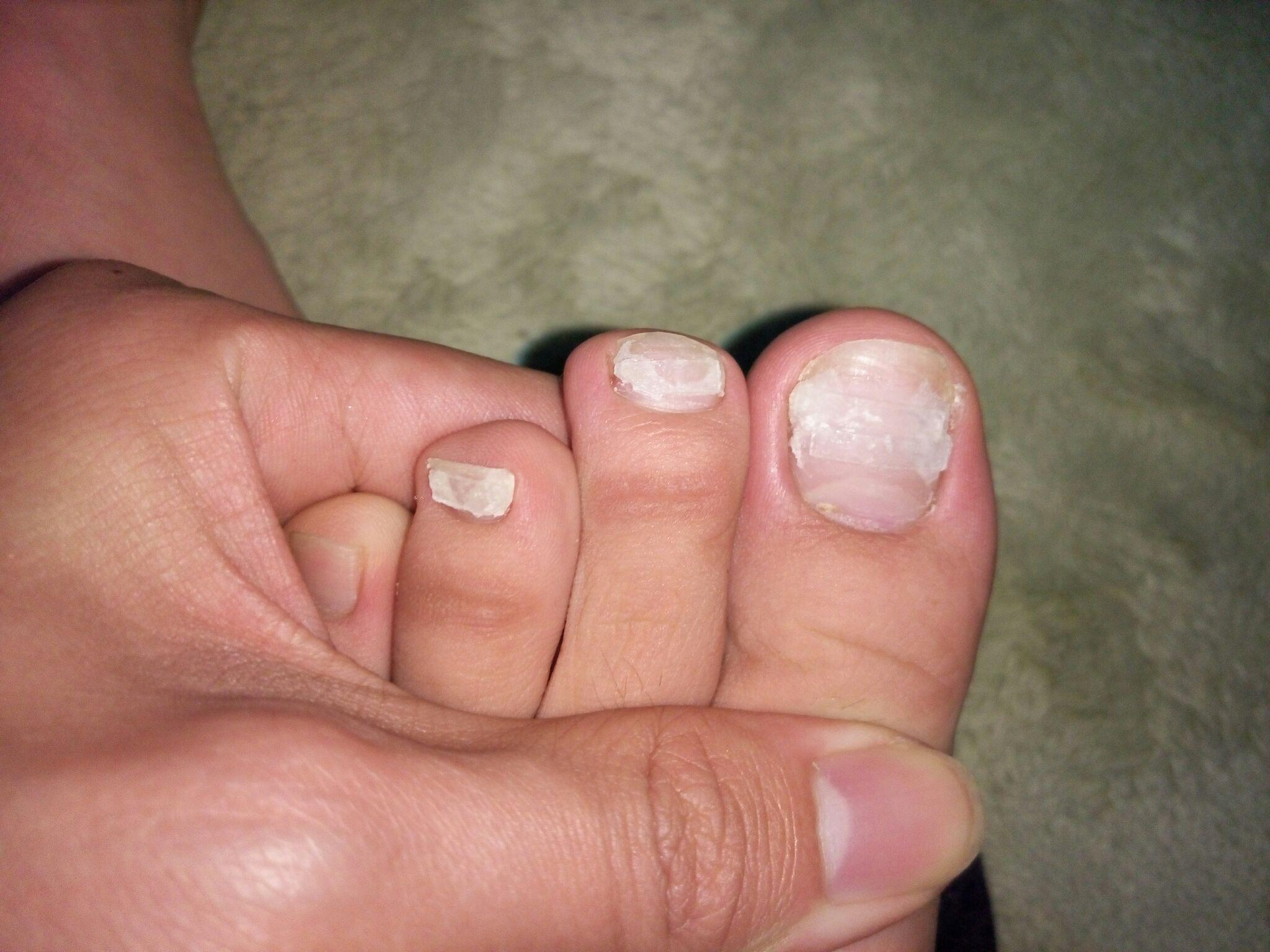 嵌甲两脚大拇指嵌甲很深每次剪指甲都要流血有好办法吗