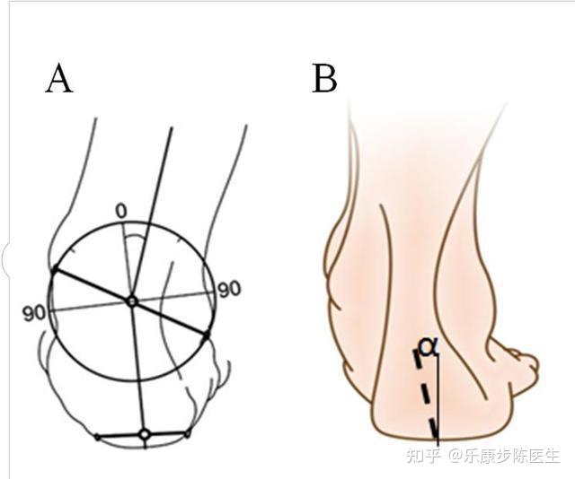 足弓塌陷,足跟軸外翻偏斜足外翻角度測量運動發育落後的兒童足外翻