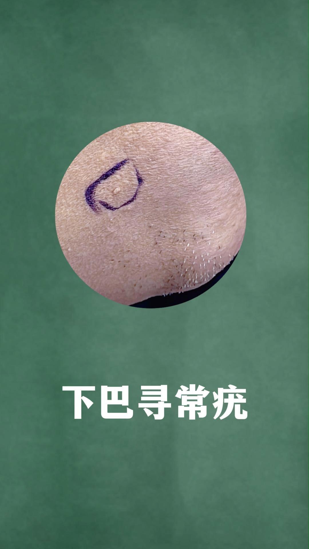 男性下巴上长寻常疣刮胡子要小心很容易刮流血导致扩散