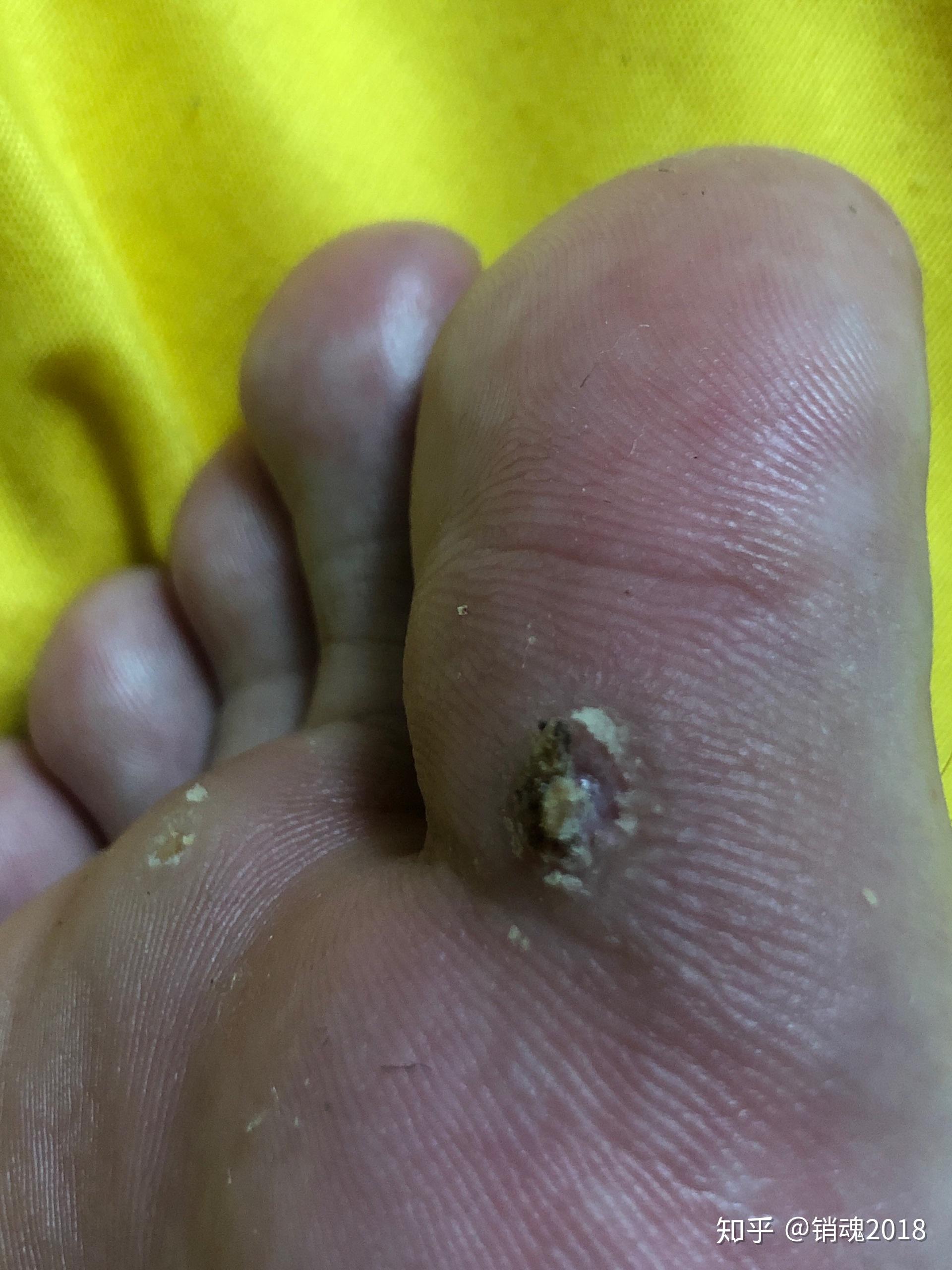 就是跖疣病毒挂了显示出来的尸体(按我的理解,一周后肤色慢慢恢复了