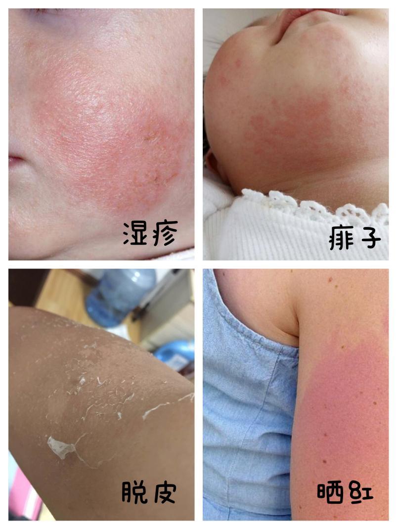 孩子皮肤干痒红敏,晒后发红,痱子刺激,有专为儿童研制的护肤品吗?