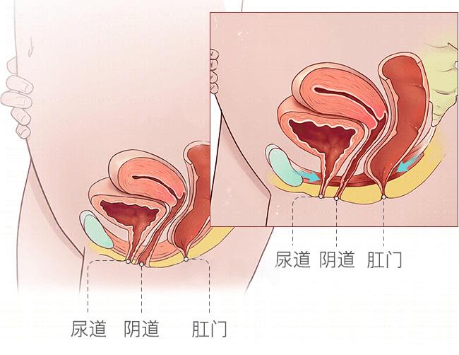 私密┃子宮怎麼會掉下來讓人尷尬又崩潰的脫垂怎麼辦