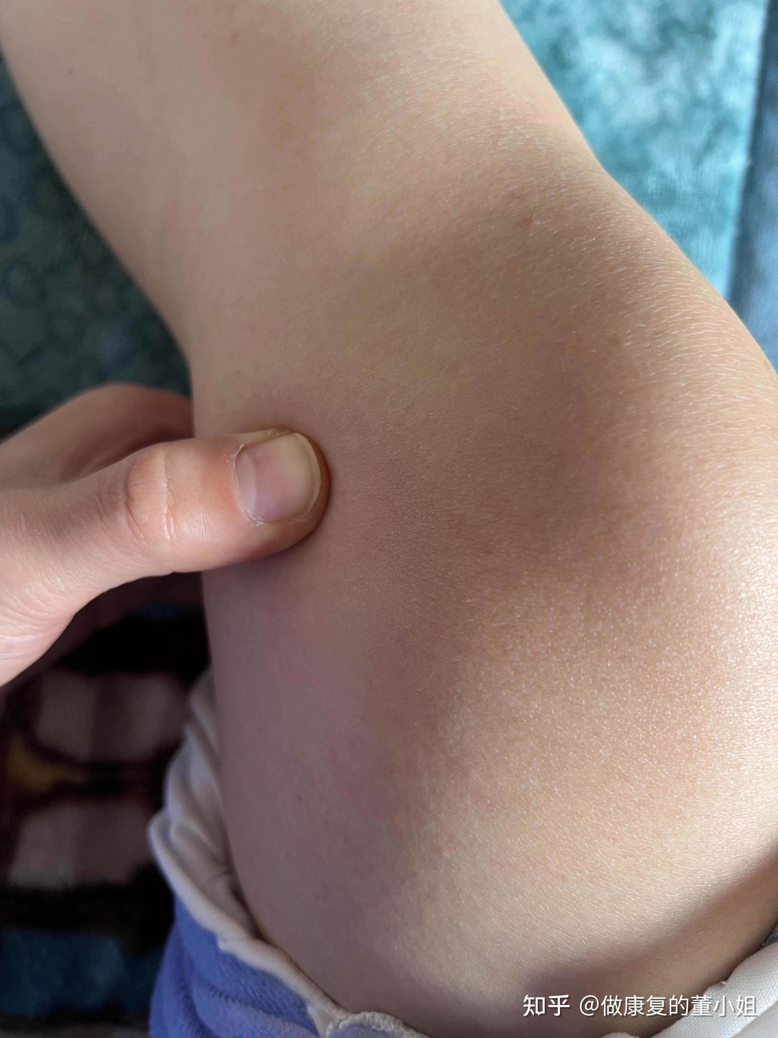 如何自行区分鹅足腱滑膜炎和半月板损伤? - 知乎