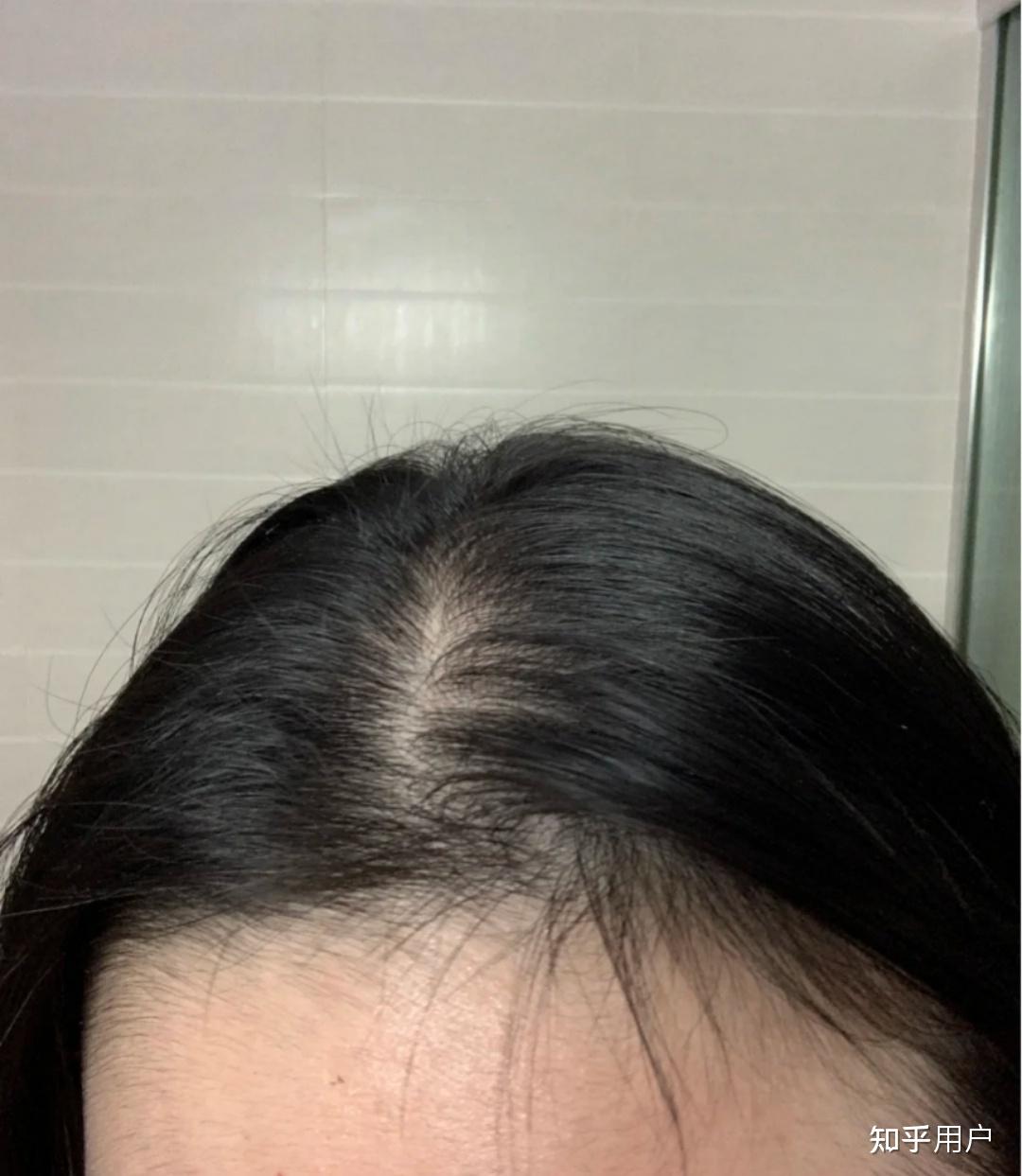 那些年得脂溢性脱发的女生最后怎么样了?