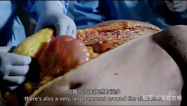 美国纪录片解剖肥胖图片