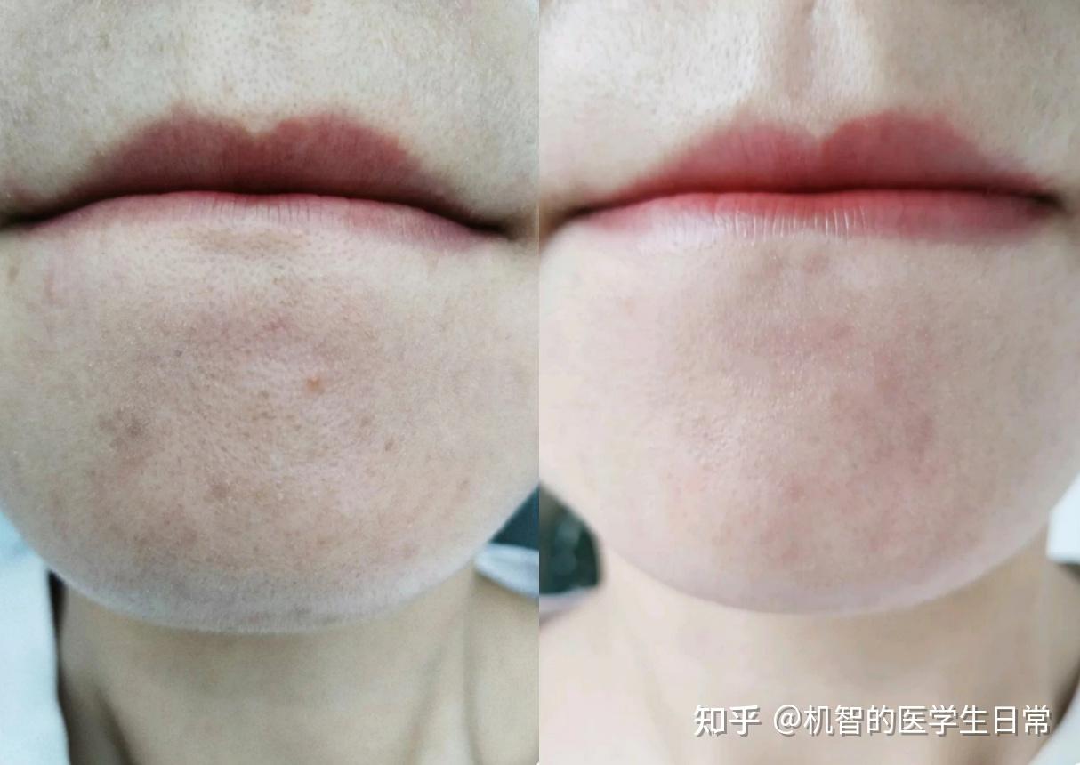 三,下巴像搓衣板,密密麻麻的闭口