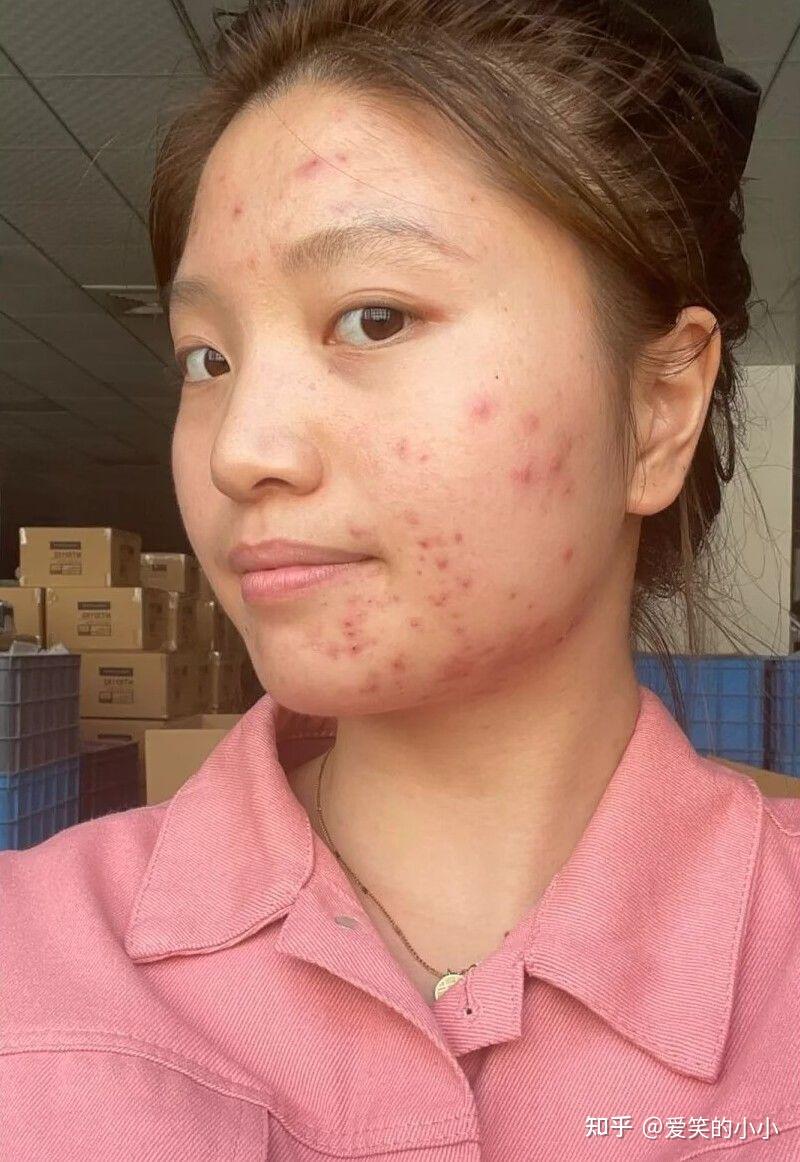 下面开始我改善痘印全程记录