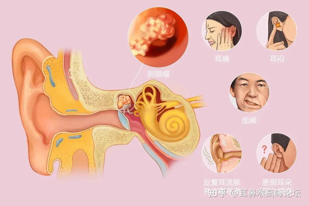 耳流脓、听力下降、鼓膜穿孔……当心中耳胆脂瘤! - 知乎