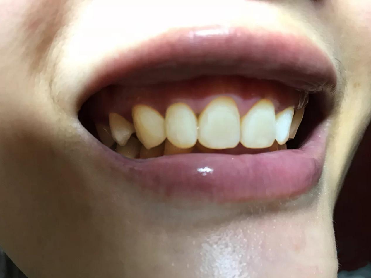 洗牙后牙齿仍旧黄,医生说是色素沉着,如何改善? 