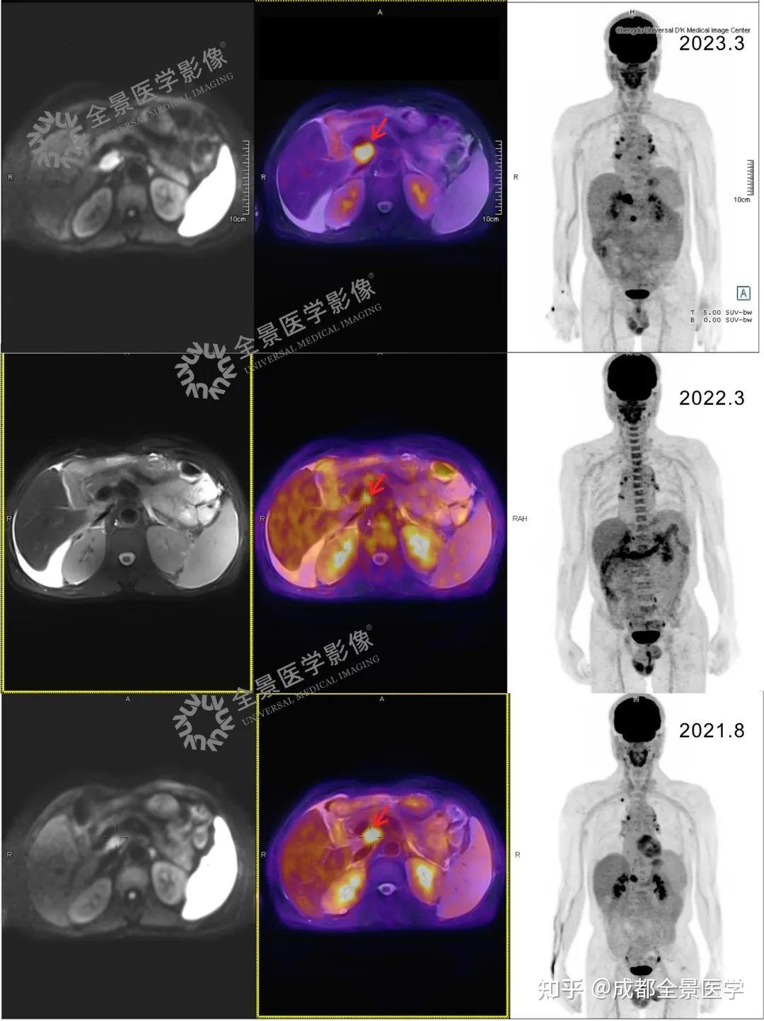 肿瘤追踪，PET/CT-MR显神通！ - 知乎