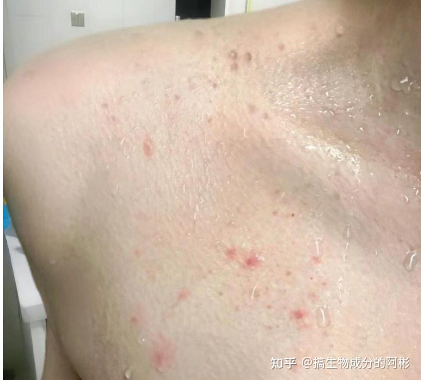 过敏泛红,出油长痘,甚至皮肤屏障受损成分安全是选择沐浴露能不能用的