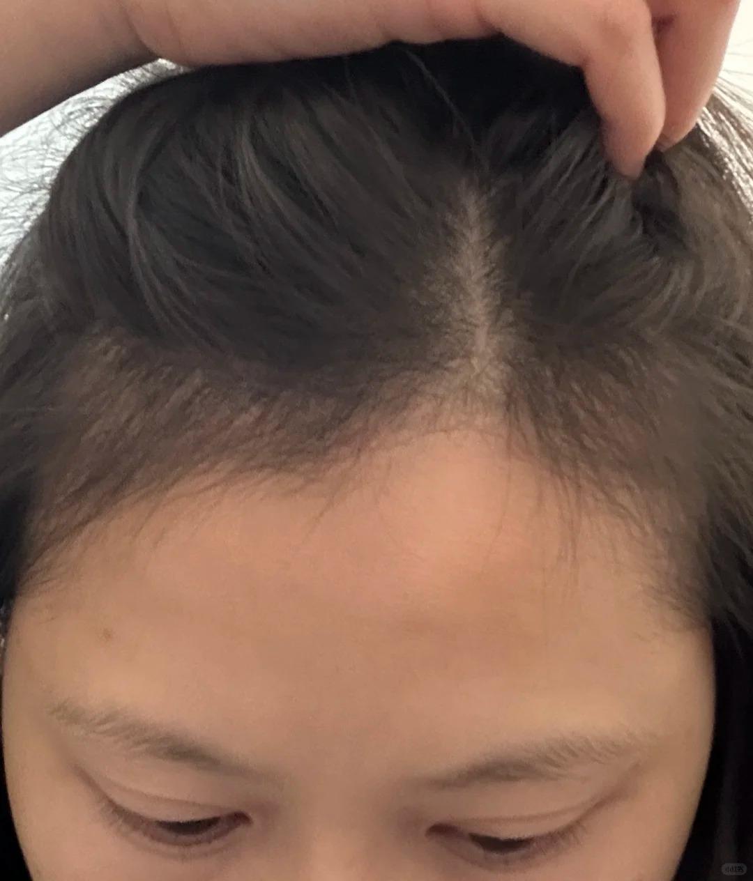女生脱发很严重该如何解决?