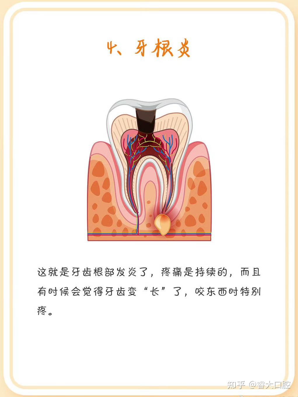8种牙痛情况,你中招了没? - 知乎