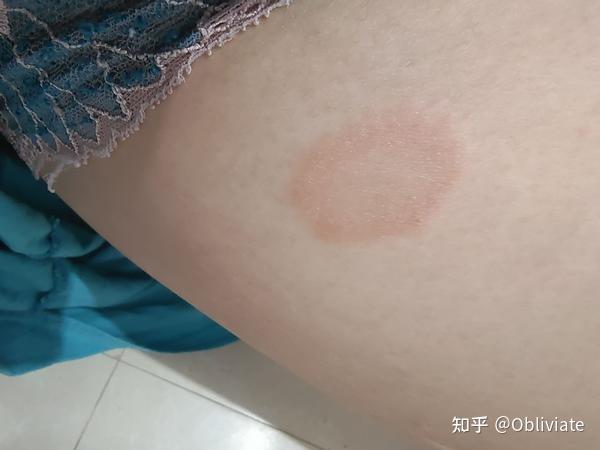 大腿湿疹症状图片图片